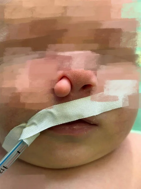 Неонатальные хирурги МОЦОМД вернули возможность дышать носом новорожденному ребенку