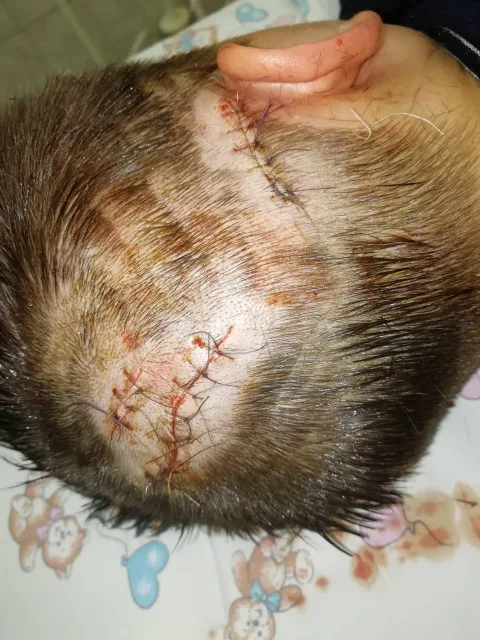 Врачи МОЦОМД Люберец оказали экстренную помощь ребёнку, пострадавшему от укусов домашнего питомца